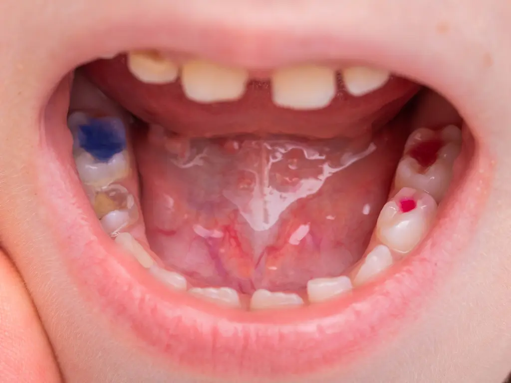 Pediatric Dental Fillings